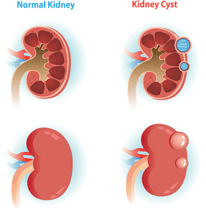Comparison Of Normal Kidney Verse A Kidney With A Cyst - Kidney Cyst, HD Png Download PNG with transparent background