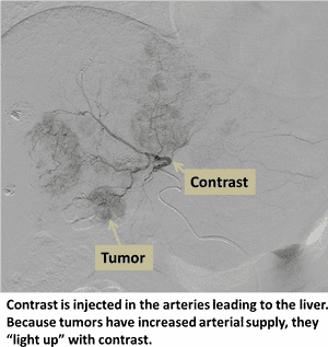 Liver Angiogram Tumor Detection PNG with transparent background