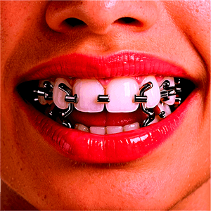 Mouth with Braces PNG 05242024 PNG