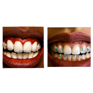 Mouth with Braces PNG ogq11 PNG