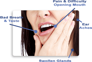 What Are The Wisdom Teeth - Wisdom Tooth Removal Pain PNG image with transparent background