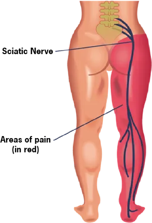 Sciatic Nerve Pain Illustration PNG Image