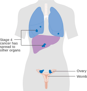 Stage4 Cancer Spread Illustration PNG image with transparent background