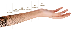 Tattoo Removal Progression Arm PNG Image