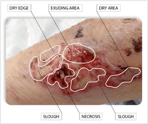Desiccation Wound, HD Png Download PNG with transparent background